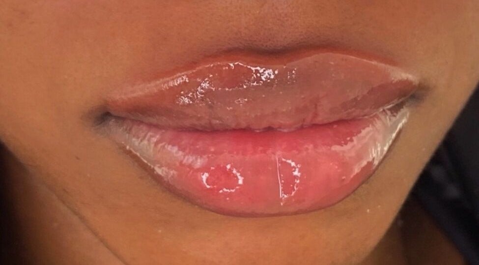 Close-up of glossy lips post-treatment at Beauty Fillers Dermal Aesthetics, London, England, GB.