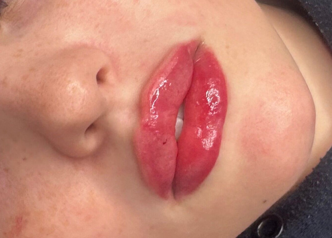 Close-up of enhanced lips at Beauty Fillers Dermal Aesthetics, London, England, GB.