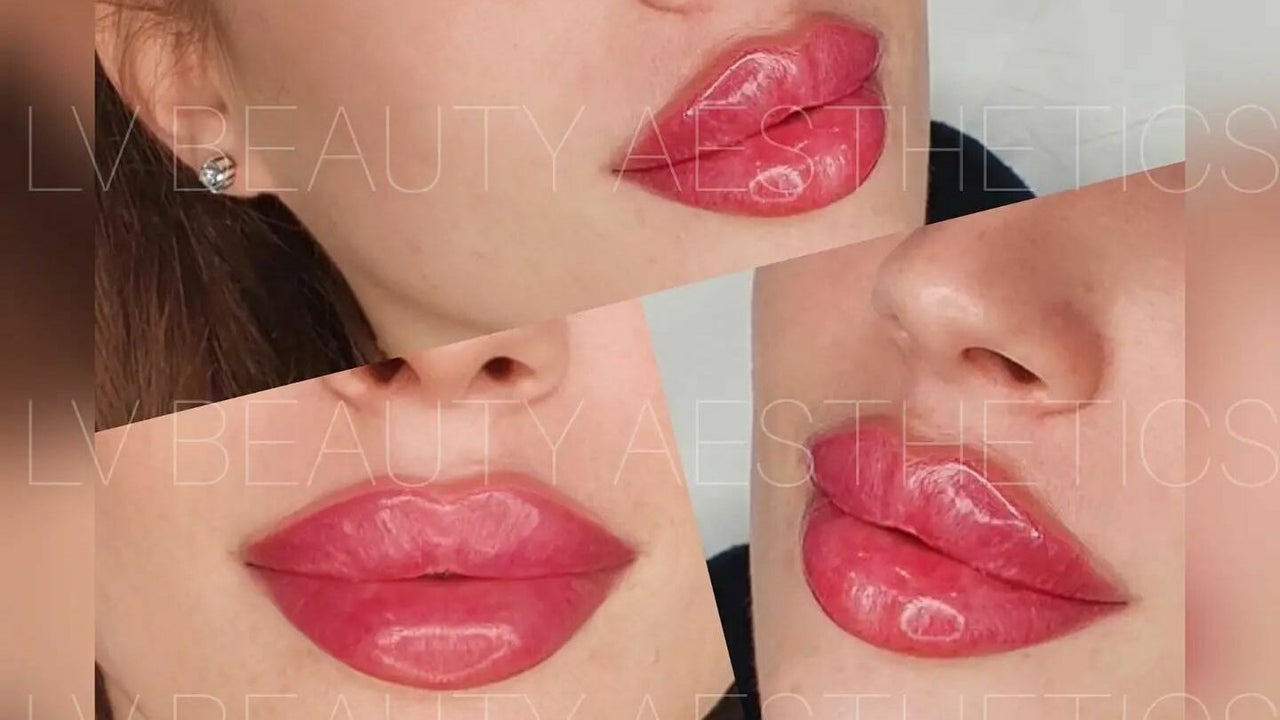 Lip Filler After Care - The Oxford Smile Clinics