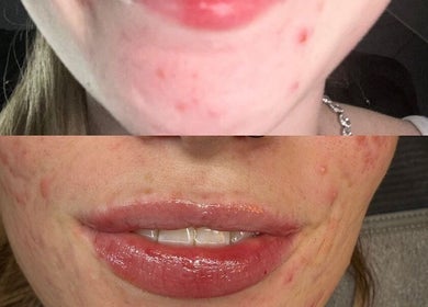Skin transformation before and after at Attvara Aesthetics, Great Kingshill, England, GB.