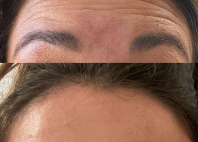 Before and after forehead rejuvenation at Attvara Aesthetics, Great Kingshill, England, GB.
