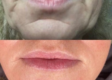 Before and after lip enhancement at Attvara Aesthetics, Great Kingshill, England, GB.