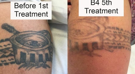 deINK Tattoo Removal image 3