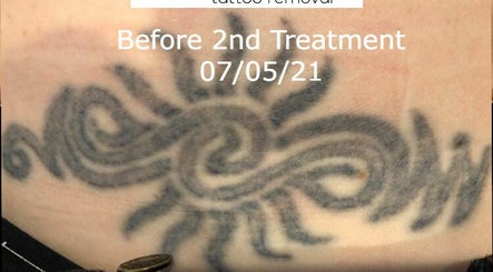 deINK Tattoo Removal image 3