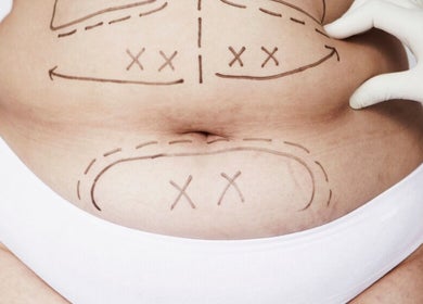Le Noir Beauty Center, Abu Dhabi: Body sculpting consultation process showing marked treatment areas.