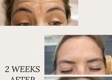 Before and after Botox treatment at JM.Aestheticsx in Stokenchurch, England, GB, showcasing forehead results.