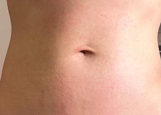 Toned abdomen post-treatment at Dyamond Sculpted, Rancho Cucamonga, California, US.