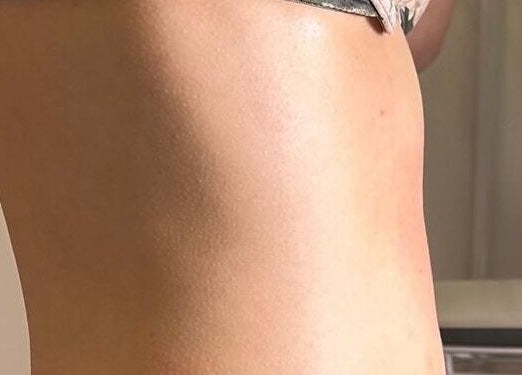 Smooth skin result from body treatment at Dyamond Sculpted, Rancho Cucamonga, California, US.