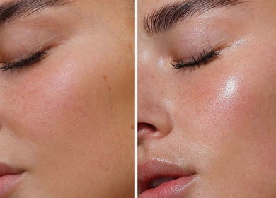 Prima e dopo trattamento pelle luminosa a SILVERÉ BEAUTY CLINIC *FREE TIME*, Lugano, Ticino, CH.