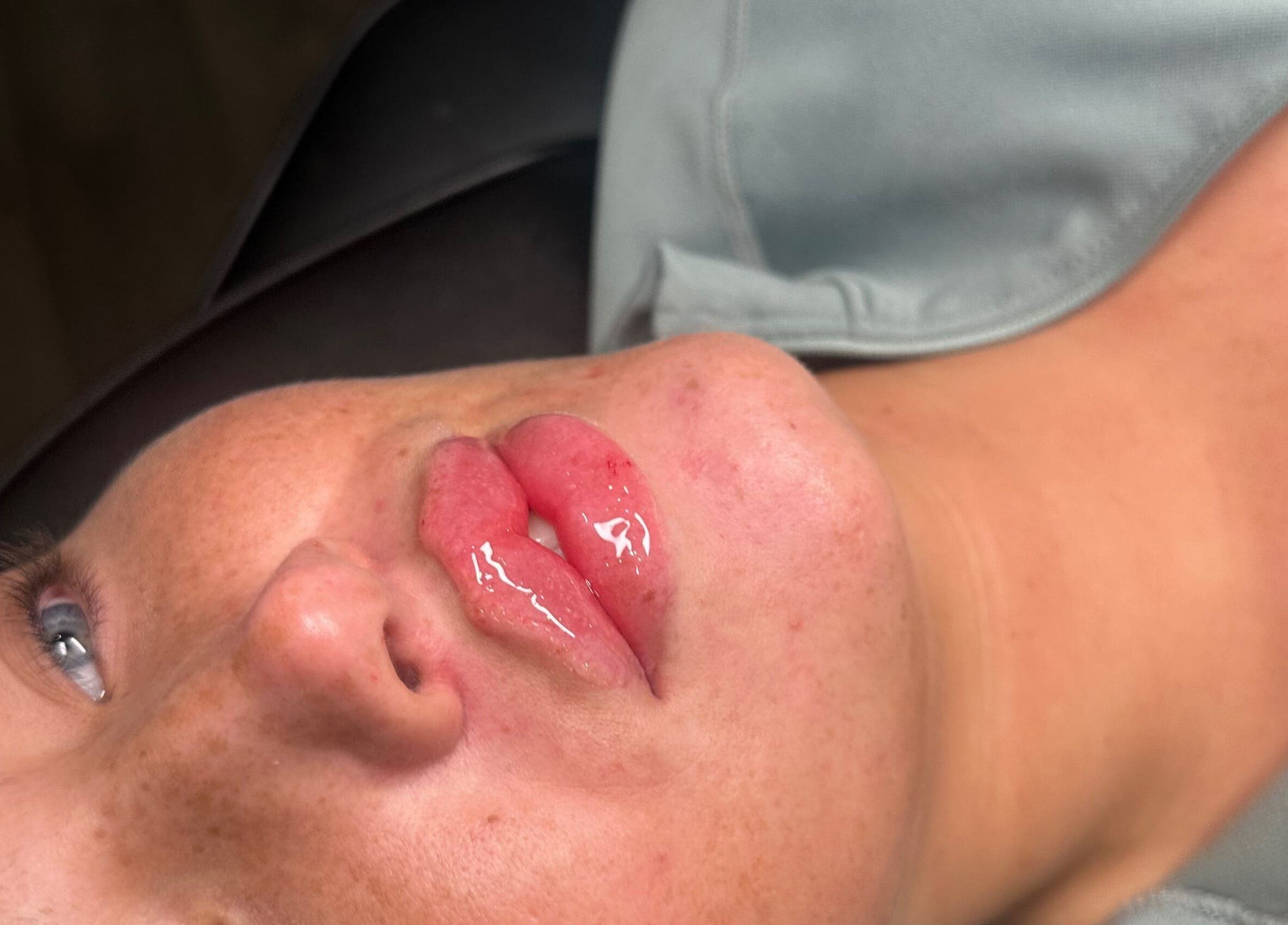 Close-up of lips with gloss treatment at Embassy Aesthetics, Walsall, England, GB.