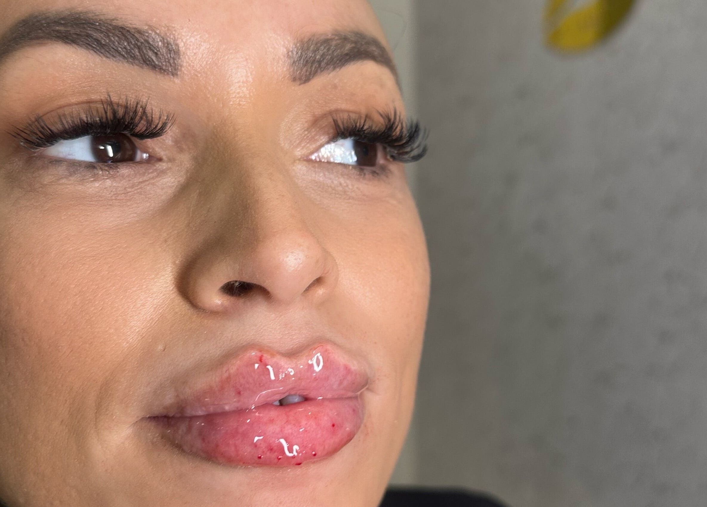 Close-up of glossy lip enhancement at Embassy Aesthetics in Walsall, England, GB.