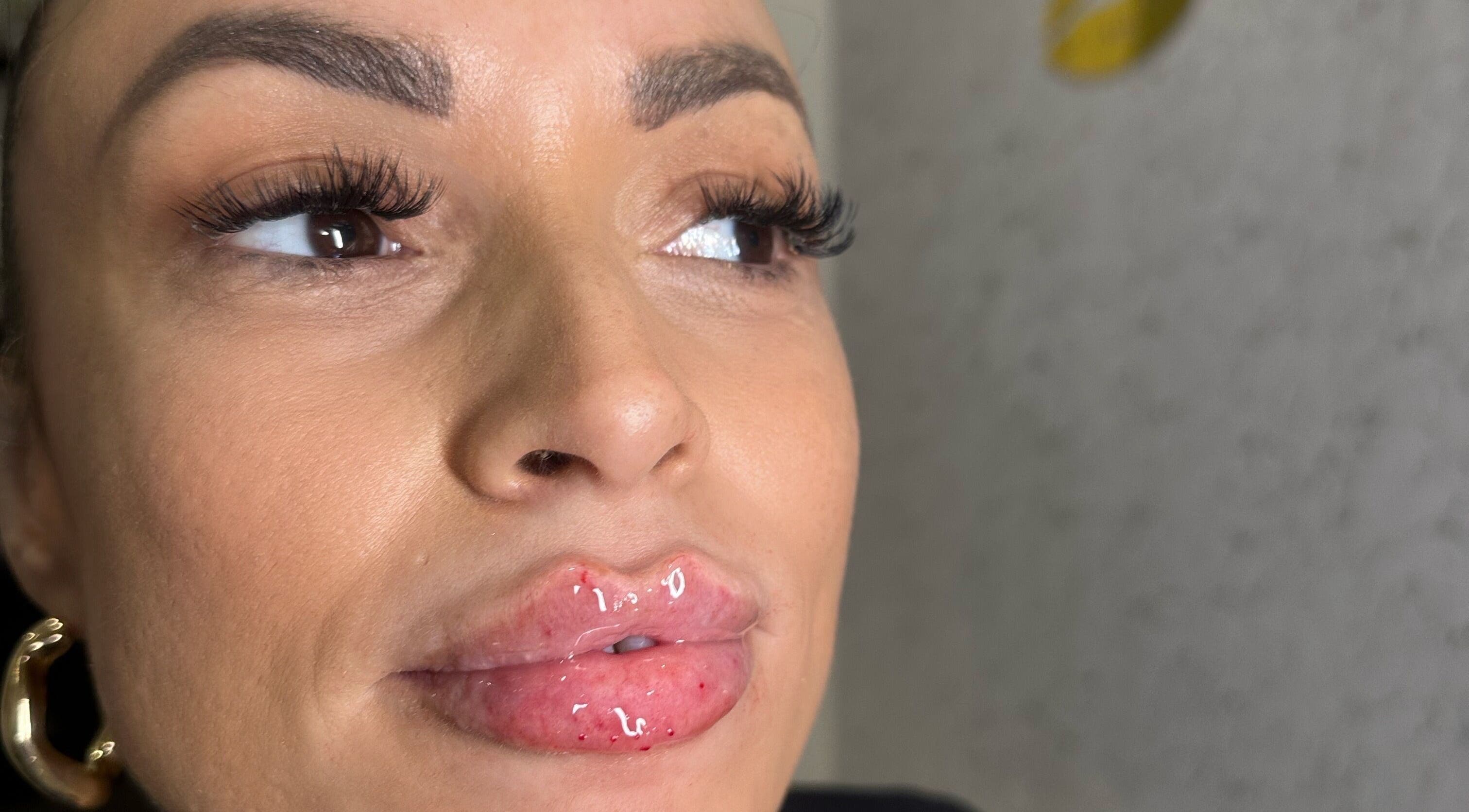 Close-up of glossy lip enhancement at Embassy Aesthetics in Walsall, England, GB.