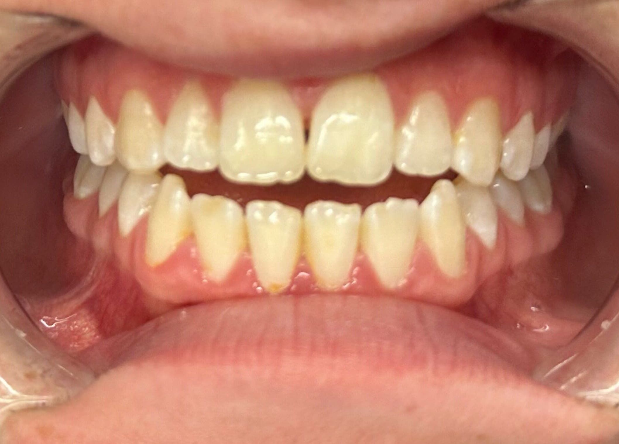 Close-up of a bright smile at Embassy Aesthetics, Walsall, England, GB, showcasing professional dental care.