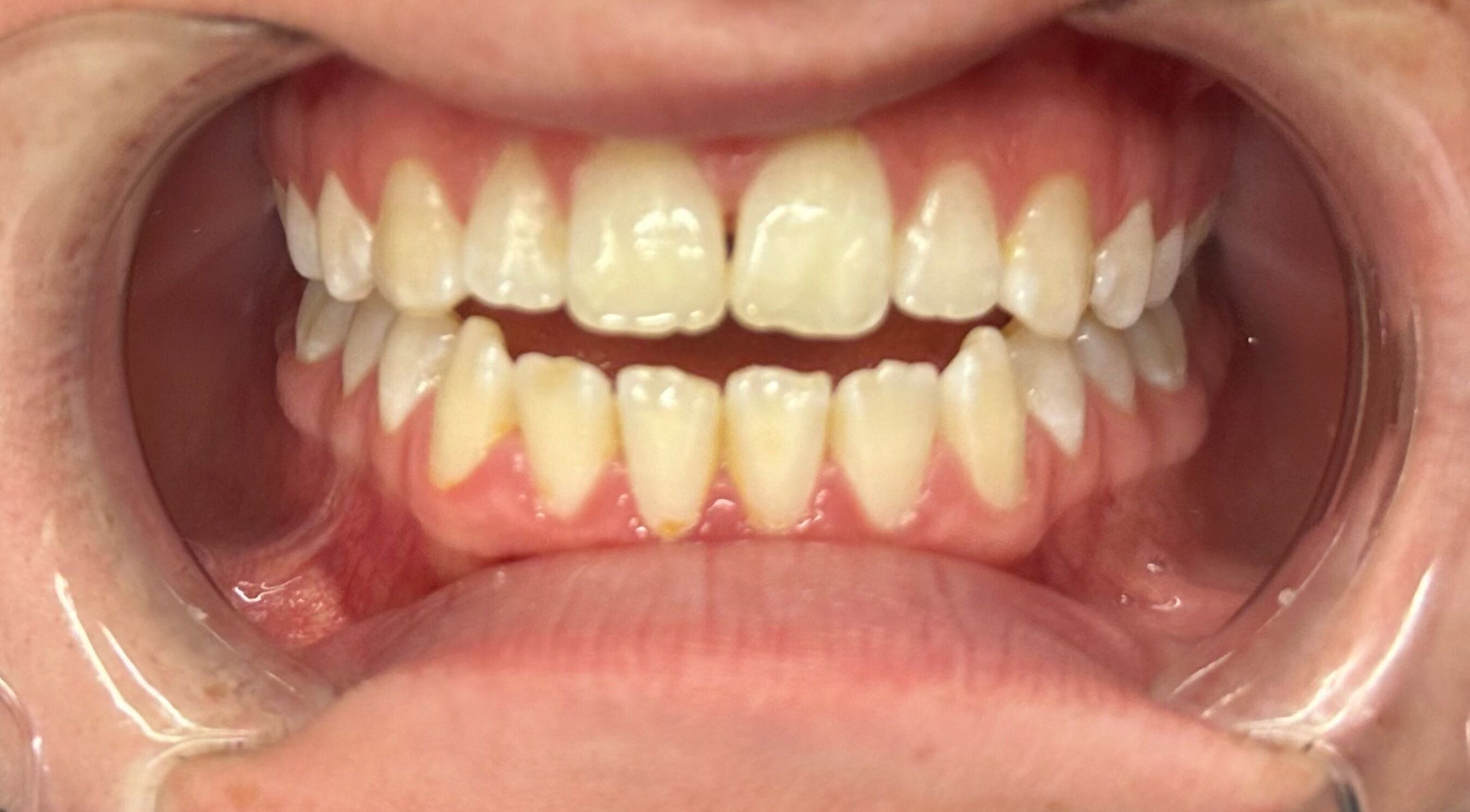 Close-up of a bright smile at Embassy Aesthetics, Walsall, England, GB, showcasing professional dental care.