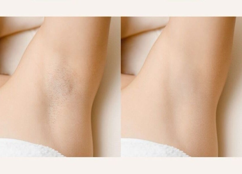 Risultati epilazione laser a Oasi del Benessere, Belpasso, Sicilia, IT. Pelle liscia e curata.