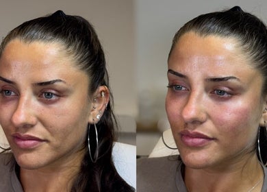 Before and after skin treatment at Skin Aesthetics by Becki Penzance, Penzance, England, GB.