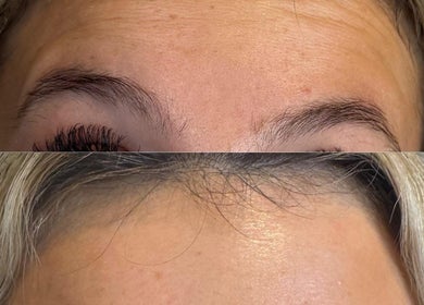 Before and after of forehead rejuvenation at Skin Aesthetics by Becki Penzance. Penzance, England, GB.