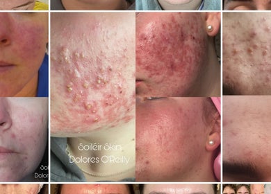 Close-up of skin treatments at Soiléir Skin By Dolores O’Reilly in Portarlington, County Laois, IE.