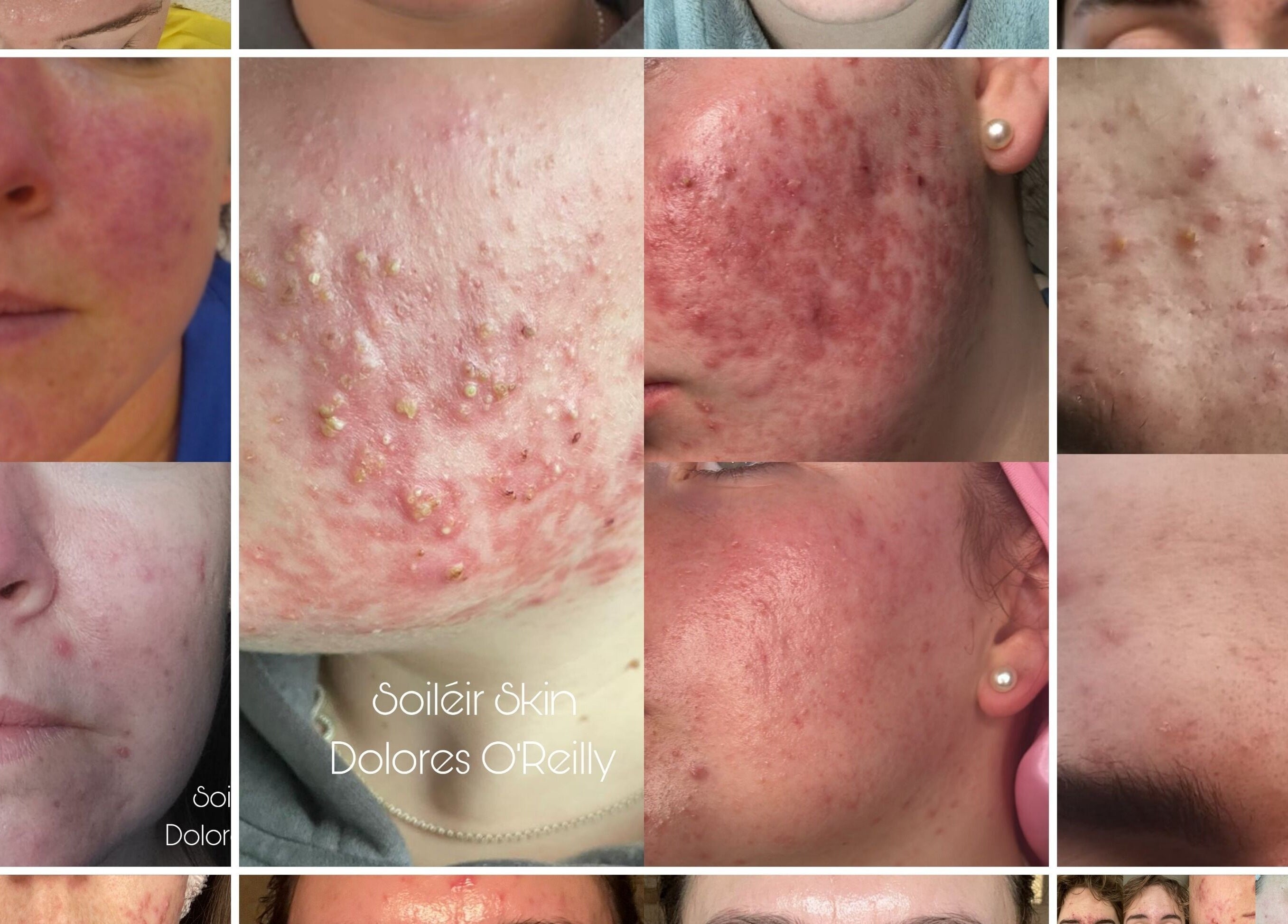Close-up of skin treatments at Soiléir Skin By Dolores O’Reilly in Portarlington, County Laois, IE.