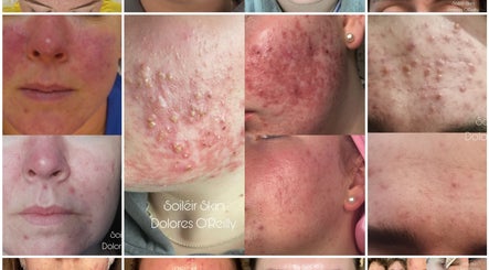 Close-up of skin treatments at Soiléir Skin By Dolores O’Reilly in Portarlington, County Laois, IE.