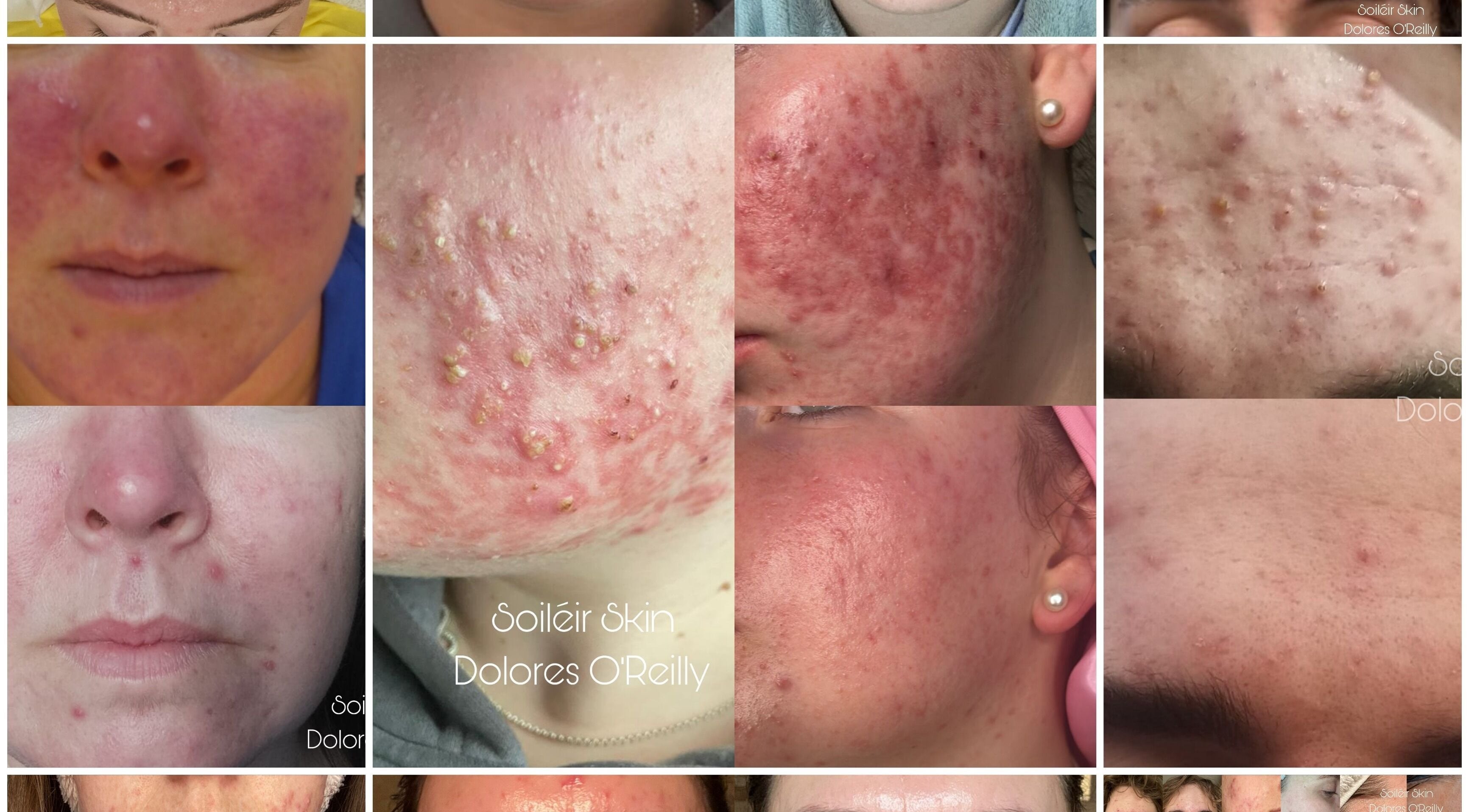 Close-up of skin treatments at Soiléir Skin By Dolores O’Reilly in Portarlington, County Laois, IE.