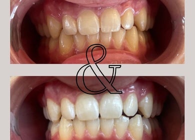 Teeth whitening results at Angelica’s Glow Bar, Maple Ridge, BC, CA, before and after comparison.