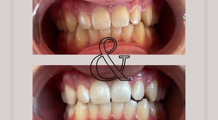 Teeth whitening results at Angelica’s Glow Bar, Maple Ridge, BC, CA, before and after comparison.