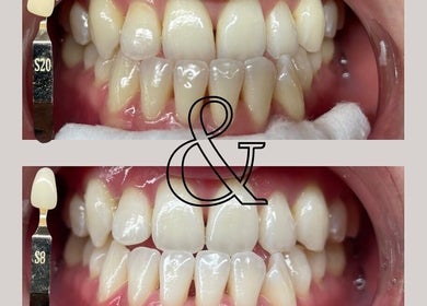 Before and after teeth whitening at Angelica’s Glow Bar, Maple Ridge, British Columbia, CA.