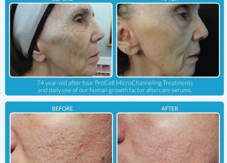 Before and after skin treatments at Angelica’s Glow Bar, Maple Ridge, British Columbia, CA.