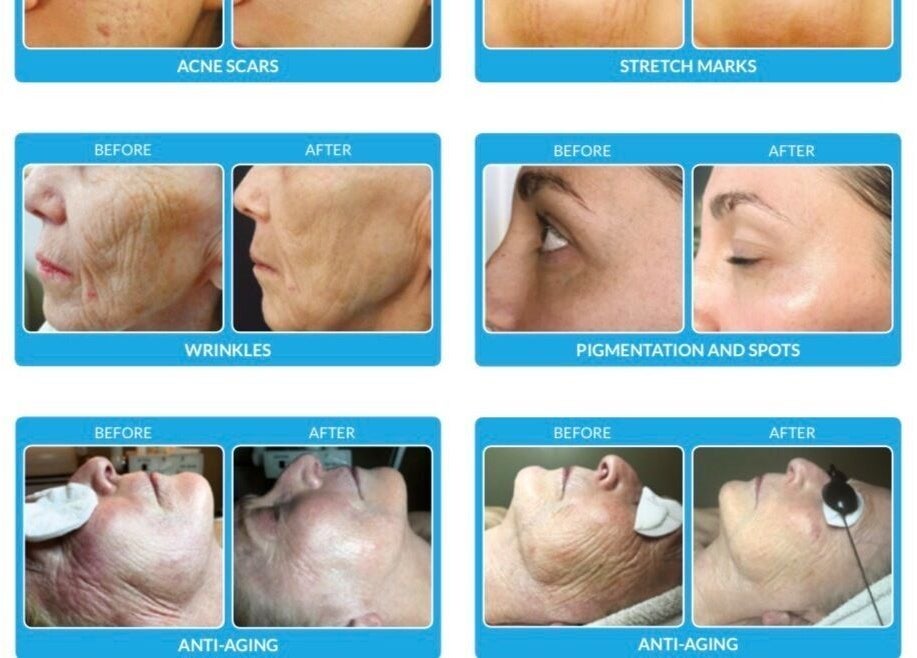 Before and after skincare results at Angelica’s Glow Bar in Maple Ridge, British Columbia, CA.