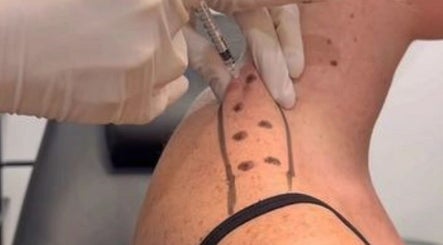 Face Aesthetics - Flat Bush (for Injectables only) image 3