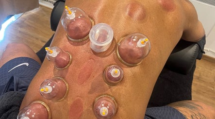 Cupping therapy session at Sport Spa Ltd, London, England, GB, promoting relaxation and wellness.