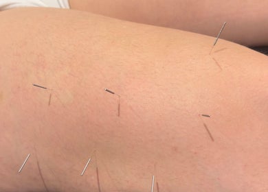 Acupuncture session at Sport Spa Ltd, London, England, GB showcasing therapeutic needles on skin.