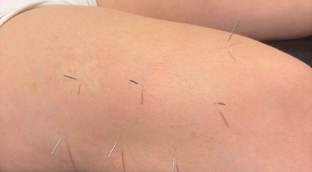 Acupuncture session at Sport Spa Ltd, London, England, GB showcasing therapeutic needles on skin.