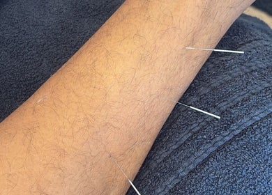 Acupuncture therapy at Sport Spa Ltd, London, England, GB promoting wellness and relaxation.