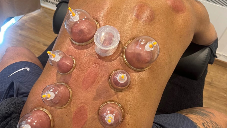 Cupping therapy session at Sport Spa Ltd, London, England, GB. Cups placed on back for relaxation.