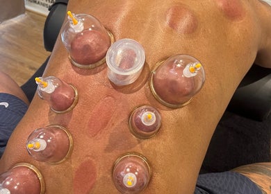 Cupping therapy session at Sport Spa Ltd, London, England, GB. Cups placed on back for relaxation.