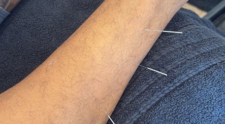 Acupuncture treatment at Sport Spa Ltd in London, England, GB, featuring needles on a relaxed arm.