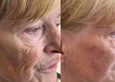 Before and after anti-aging treatment at The Bloom Aesthetics, Hereford, England, GB shows skin rejuvenation.