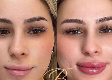 Before and after lip enhancement at The Bloom Aesthetics, Hereford, England, GB.