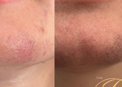 Before and after skin treatment at The Bloom Aesthetics, Hereford, England, GB highlighting chin improvement.