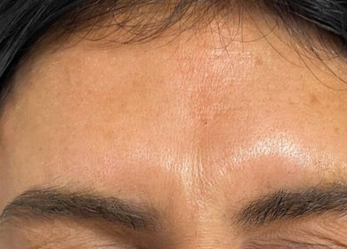 Close-up of a smooth forehead at The Bloom Aesthetics, Hereford, England, GB.