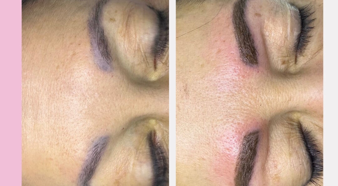 Eyebrow enhancement at Glow Beauty and Aesthetics Studio, Pretoria, Gauteng, ZA, before and after results.