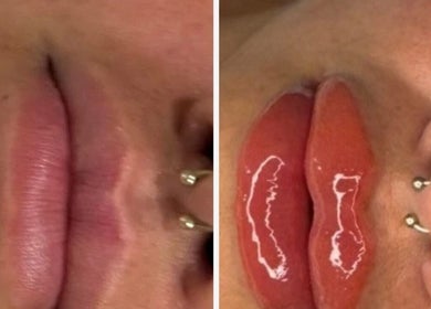 Before and after lip enhancement at Contour Me, Aubin Grove, Western Australia, AU.