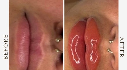 Before and after lip enhancement at Contour Me, Aubin Grove, Western Australia, AU.