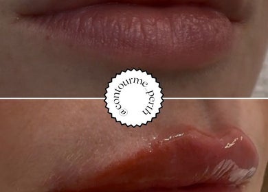 Before and after lip enhancement at Contour Me, Aubin Grove, Western Australia, AU.