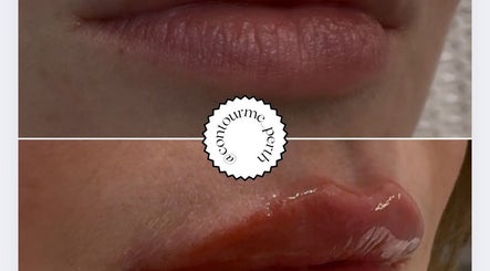 Before and after lip enhancement at Contour Me, Aubin Grove, Western Australia, AU.