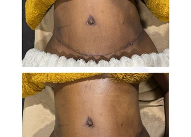Before and after body sculpting at Contour Me, Aubin Grove, Western Australia, AU. Visible skin enhancement.