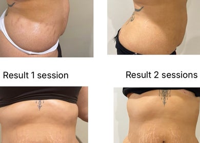 Body sculpting results after sessions at Contour Me, Aubin Grove, Western Australia, AU.