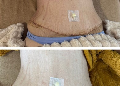 Healing neck post-treatment at Contour Me, Aubin Grove, Western Australia, AU, showcasing recovery progress.